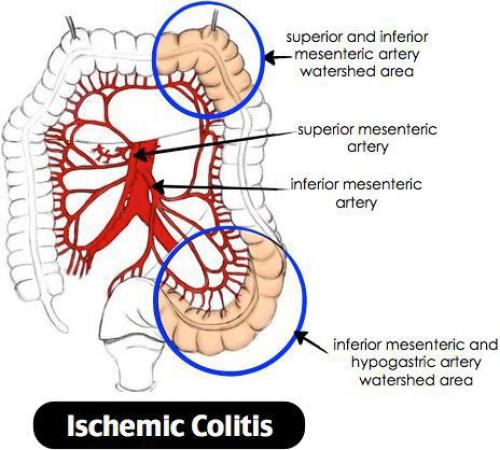 Полное руководство по лечению воспаления кишечника у взрослых 02