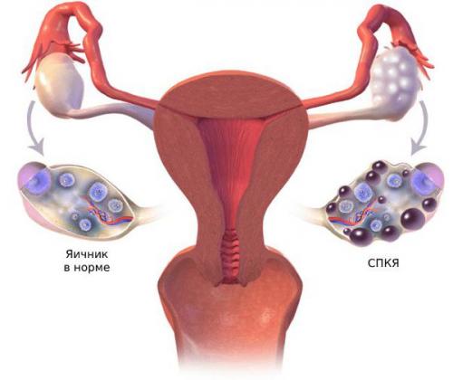 Гормональный дисбаланс и нарушение работы яичников: причины, симптомы, лечение 01