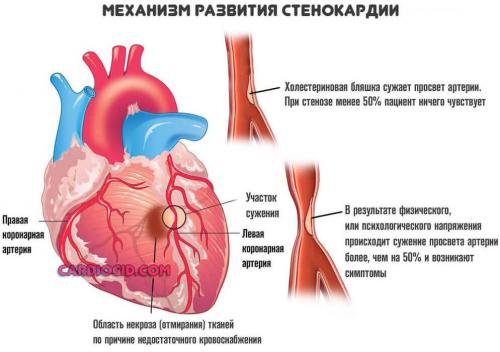 Возможно ли полное излечение сердца или лечение направлено на сдерживание состояния. Причины замирания сердца, симптомы требующие обращения к врачу и методы лечения