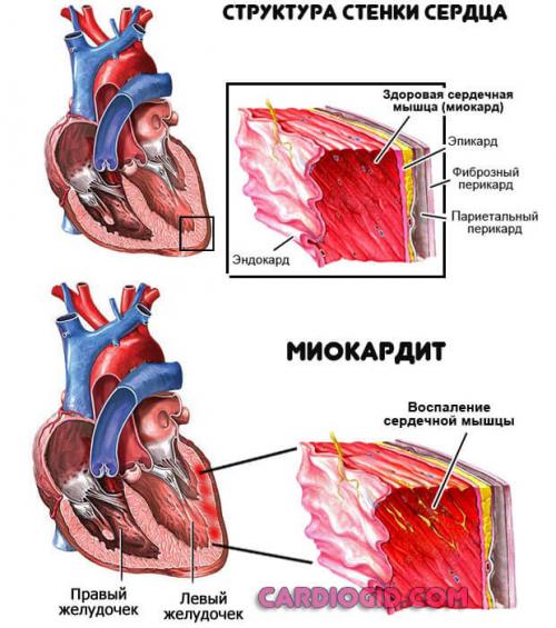 Возможно ли полное излечение сердца или лечение направлено на сдерживание состояния. Причины замирания сердца, симптомы требующие обращения к врачу и методы лечения