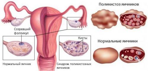 Какие продукты восстанавливают здоровье яичников 03 Какие продукты восстанавливают здоровье яичников 03