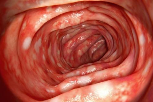 Как правильно комбинировать лекарственные препараты при комплексном лечении колита. Рекомендации по лечению болезни Крона и колита в Европе