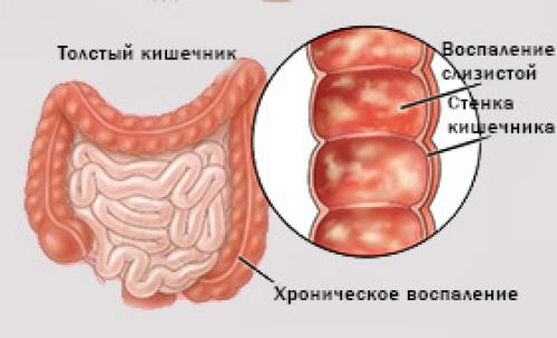 Все, что нужно знать о колите кишечника у взрослых: симптомы, причины, лечение 02